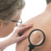 Melanoma, la forma más agresiva de cáncer de piel