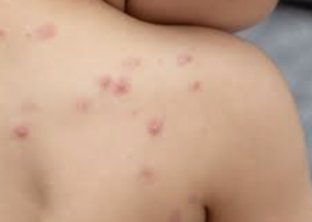 Llega la Viruela del Mono a México