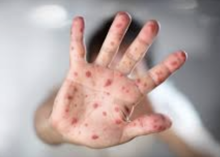 Viruela del mono ya está en Jalisco