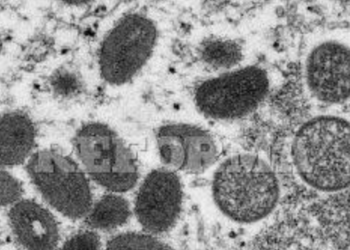 Confirman segundo caso de Viruela del Mono en México