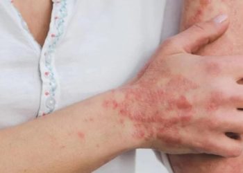 Registra Edoméx primeros dos casos de viruela del mono